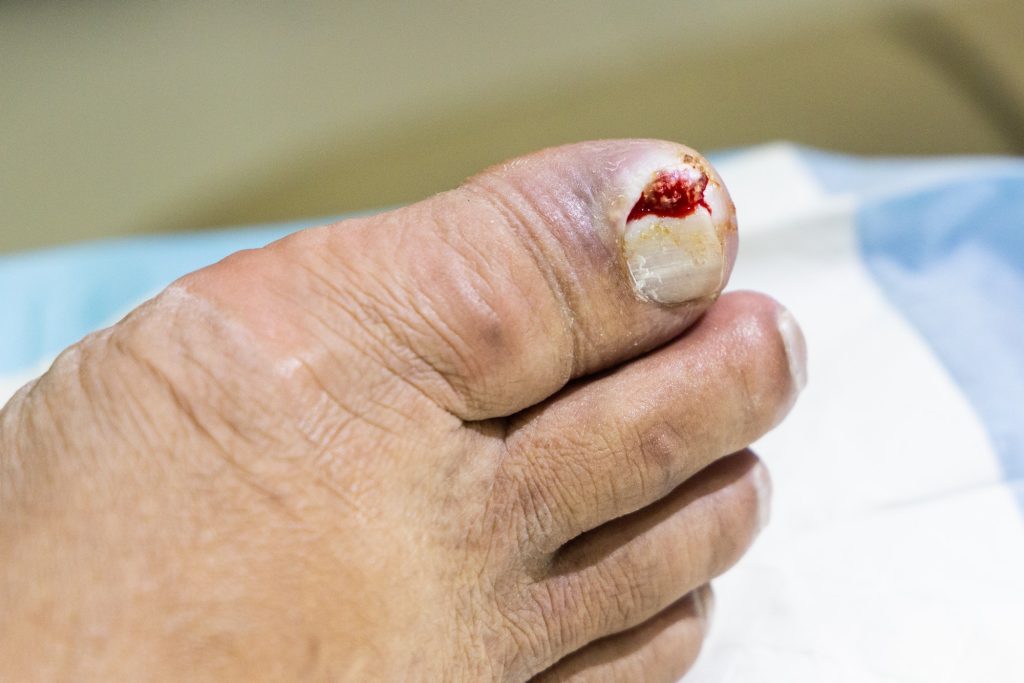 Foot with ingrown toenail painful infection ready to be treated